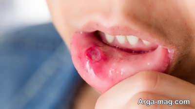 علایم سرطان دهان را جدی بگیرید