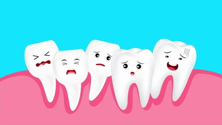 انواع کراودینگ دندان, نامرتبی دندانها, کراودینگ دندان چیست