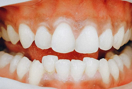 کشیدن دندان برای حل مشکل کراودینگ, روش های درمان کراودینگ, کراودینگ