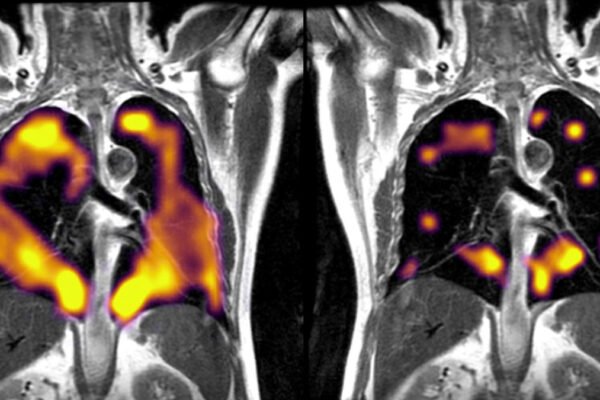 فناوری جدید تصویربرداری می‌تواند آسیب ریوی پنهان بیماران مبتلا به کرونا را تشخیص دهد