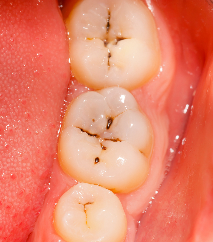 اختصاصی| چرا به شقاق دندانی مبتلا می‌شویم؟