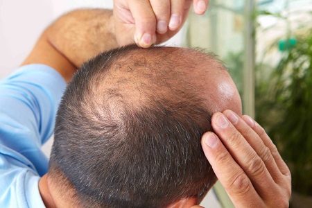 ریزش مو ارثی در سن ۱۸, کنترل ریزش مو ارثی, داروی ضد ریزش مو ارثی مردان