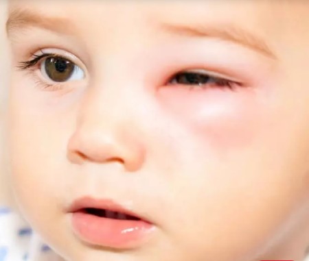 سلولیت چشمی در کودکان چیست,سلولیت چشمی در کودکان ,درمان سلولیت چشمی در کودکان