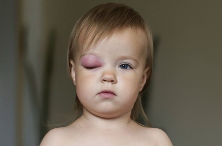 سلولیت چشمی در کودکان چیست,سلولیت چشمی در کودکان ,انواع سلولیت چشمی در کودکان