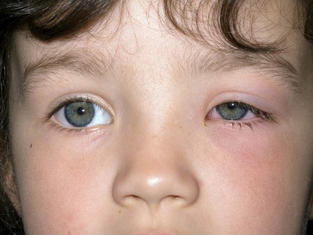 سلولیت چشمی در کودکان چیست,سلولیت چشمی در کودکان ,آیا می توان از پیدایش سلولیت چشمی در کودکان پیشگیری کرد