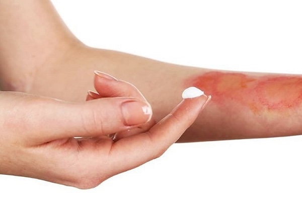 درمان سریع سوختگی پوست در اثر روغن داغ با گذاشتن این مواد غذایی روی محل آسیب دیده