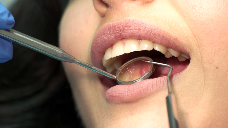 کشیدن دندان‌ عقل ضروری است؟
