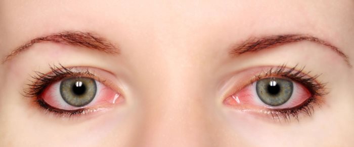 درمان برق زدگی چشم با ۱۰ راهکار خانگی