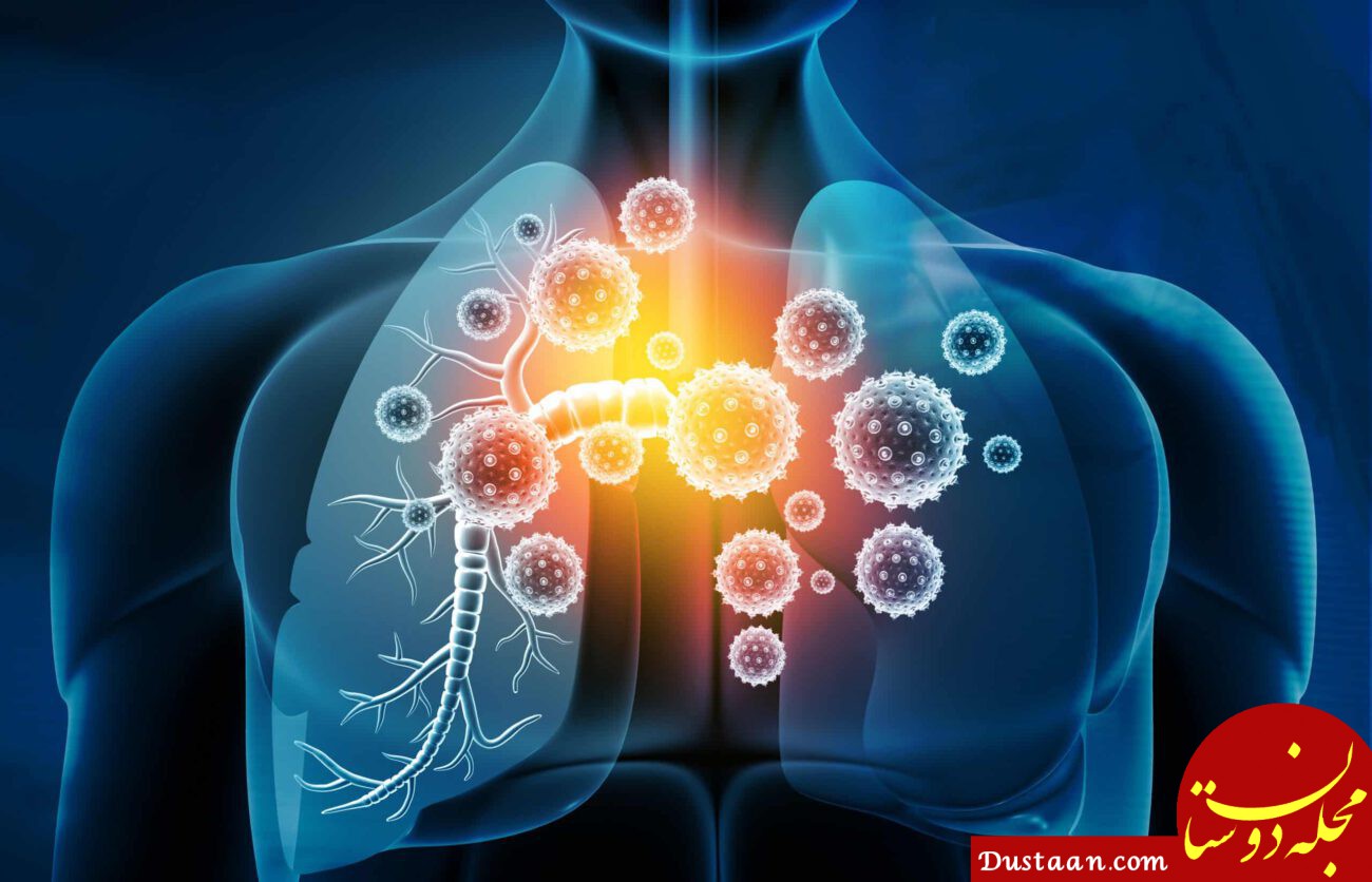 درمان آنفولانزا ذات الریه سل در طب سنتی