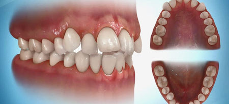 کراودینگ دندان چیست و چگونه درمان می شود؟