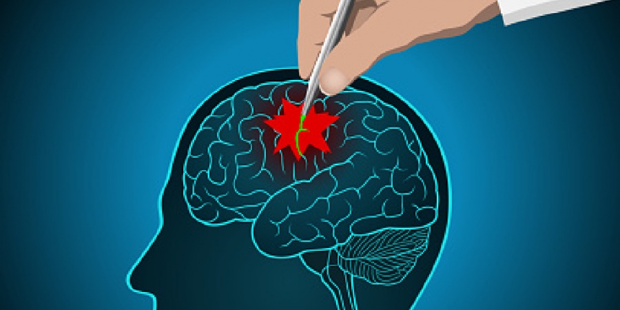 پاندمی کرونا باعث بی توجهی به تومور مغزی نشود