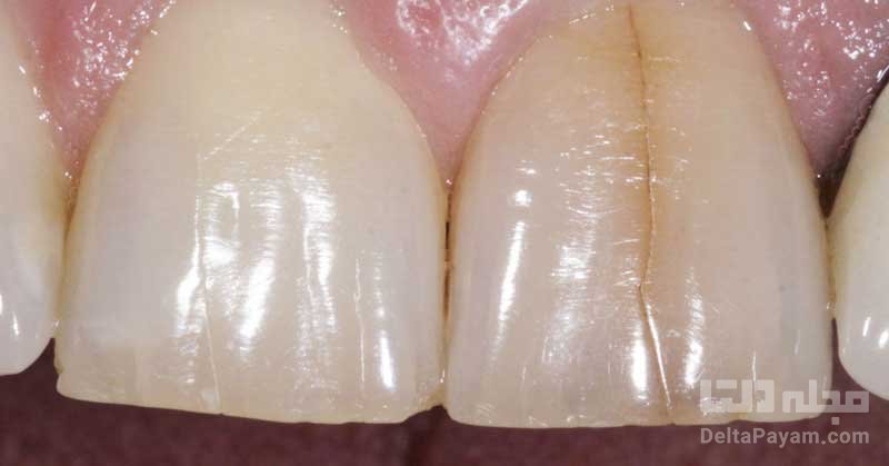 علت ترک خوردن دندان چیست؟ چگونه درمان می‌شود؟