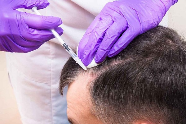 درمان ریزش مو با هیر فیلر چگونه انجام می‌شود؟