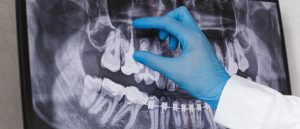 درمان مجدد ریشه دندان چیست؟