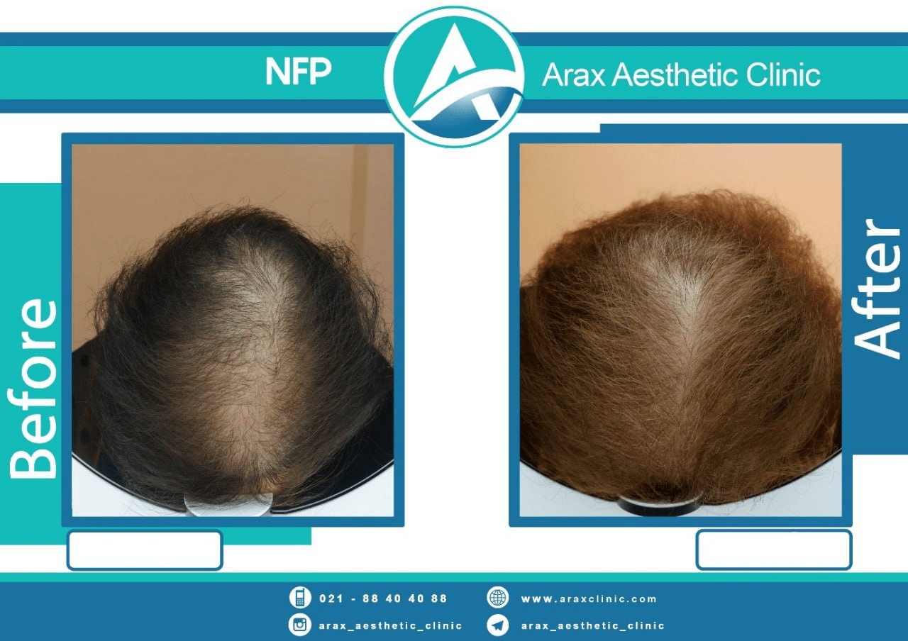در روش درمان ریزش موی NFP چربی مایع استخراج و خالص‌سازی شده
