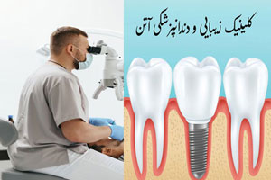 ایمپلنت دندان با شرایط پرداخت اقساط