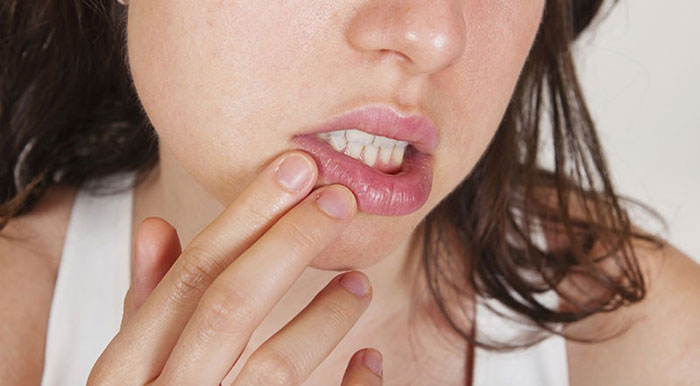 آفتوژل (Aftogel)، اولین داروی موثر در درمان آفت دهان